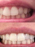 Awesome Tips To Help With Teeth Whitening